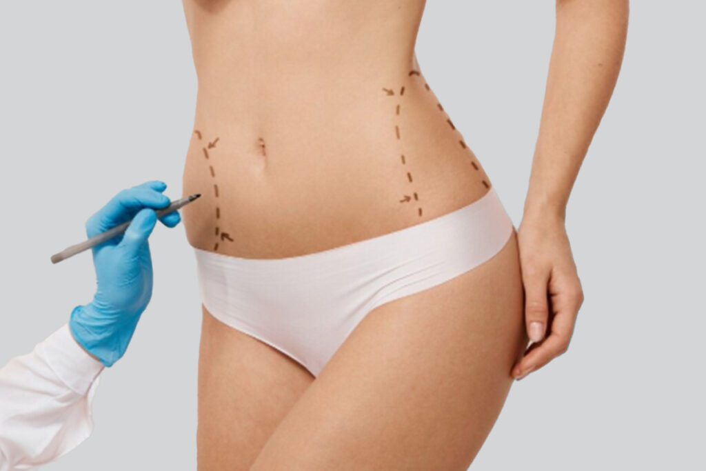 Abdominoplastyka w Turcji