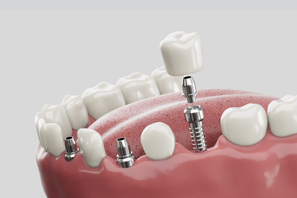 Implant w Turcji